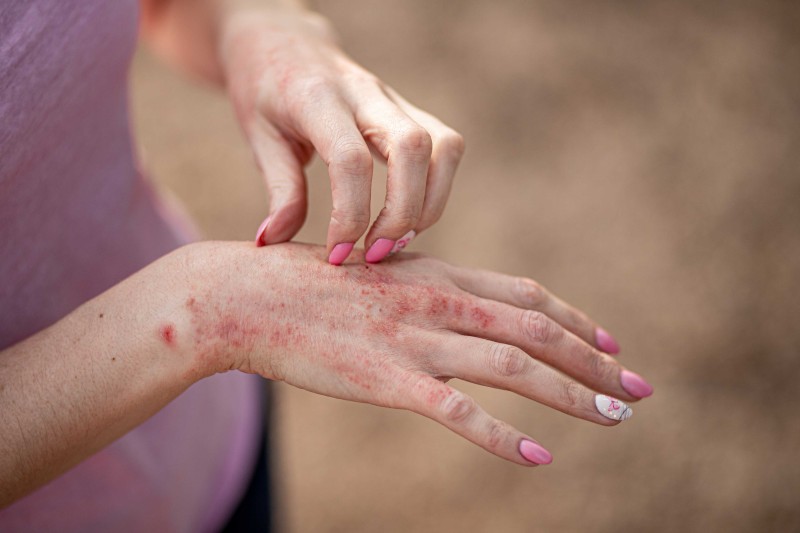 A woman scratching a hand with eczema on it