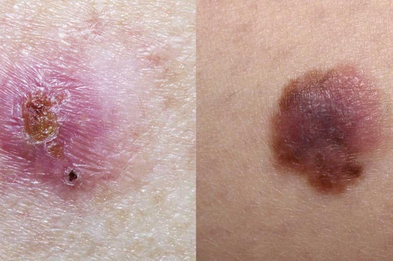 Examples of cancerous moles